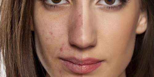 acne baixo teor de carb